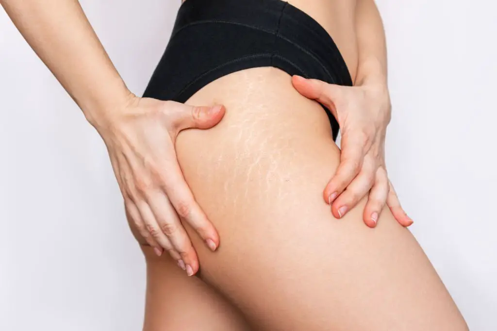 Say Goodbye to your Stretch Marks