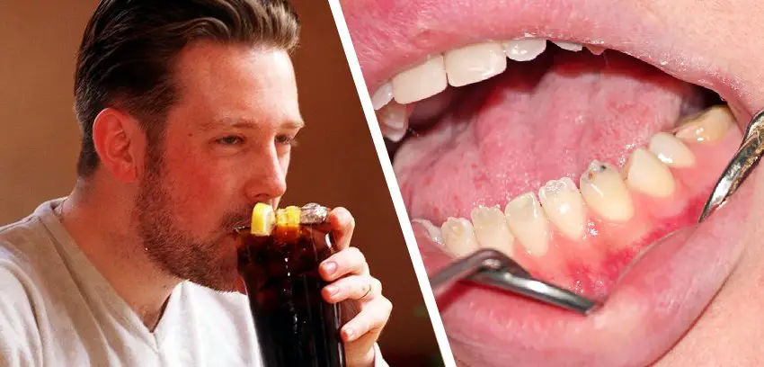 Drinking Soda Can Destroys dental enamel.